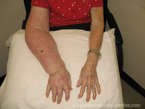 lymphedema hardening cellulitis infection